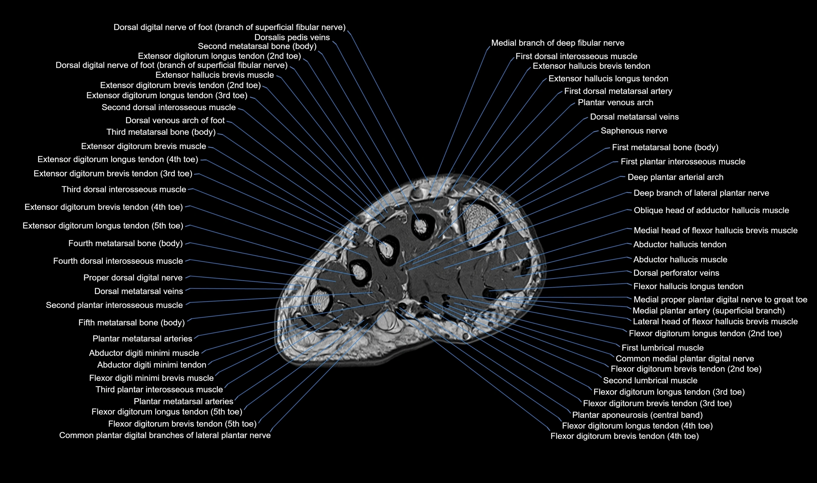 MRI mid foot axial cross sectional anatomy 3T  radiology  image-img-00001-00003.webp